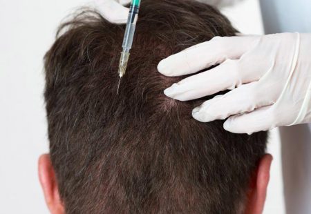 Treatment of hair loss with plasma technology