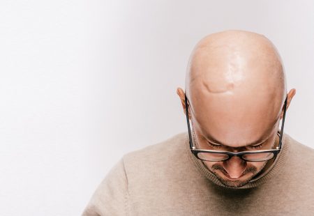 زراعة الشعر فوق الندبات والجروح