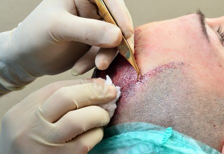 زراعة الشعر بتقنية الاقتطاف