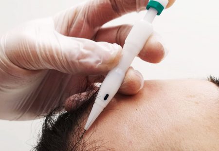زراعة الشعر بتقنية تشوي (CHOI) - قلم تشوي