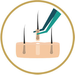 تقنيات زراعة شعر ناجحة بدون ألم
