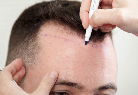 فوائد زراعة الشعر مقارنة بحلول مشكلة الصلع الأخرى