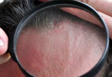 البثور والحبوب بعد عملية زراعة الشعر وكيفية علاجها