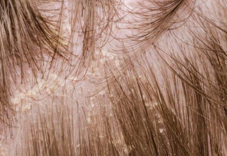 القشرة بعد زراعة الشعر متى تزول وكيفية القضاء عليها
