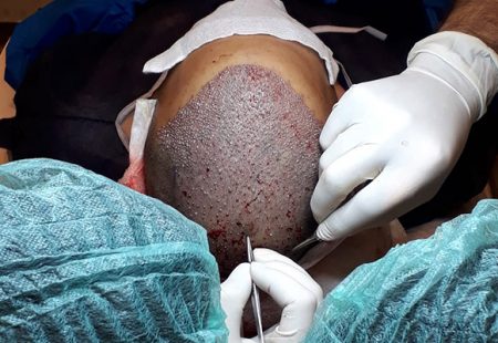 زراعة الشعر بتقنية الاقتطاف - ما هي تقنية الاقتطاف