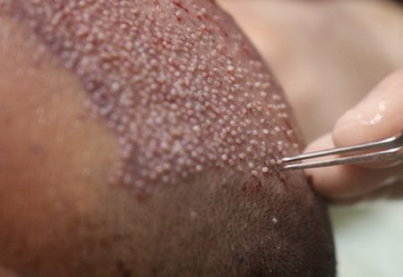 زراعة الشعر بتقنية الاقتطاف - بدون ضمادات أو جروح