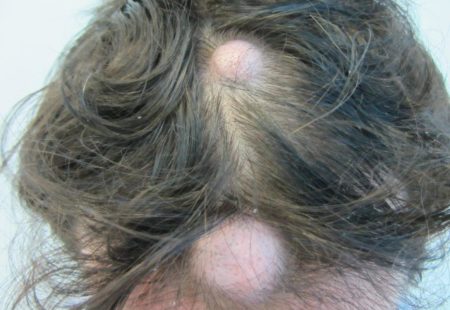 علاج الثعلبة بزراعة الشعر