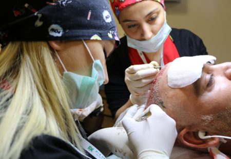 عملية زراعة شعر